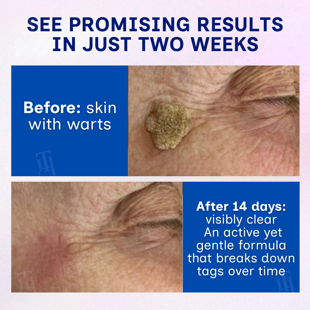 🌟 Official Store | 🛡️ The 'Glue Stick' Secret to Clear Skin! RZXEA™ Solid-Stick Wart Remover